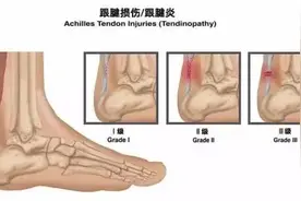 跟腱断裂后，手术和保守治疗哪个好？图片
