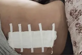 腰椎取钢钉手术亲身体验图片