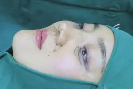 垫鼻基底后，嘴唇发麻是正常现象吗？图片