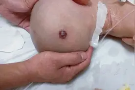 小孩仰面摔倒，一颗钉子钉在后脑上，医生提醒：千万不要自行拔出图片