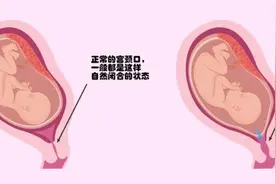 试管双胞胎遭遇宫颈松弛，一胎流产，另一胎24天后出生图片
