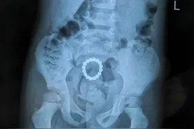 磁力珠被孩子误食后会发生什么？答：有可能肠道会“乱套”图片