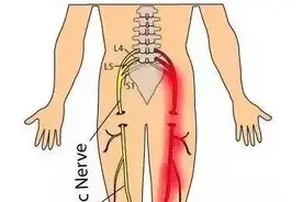 坐久了会得坐骨神经痛？也许暗藏玄机！图片