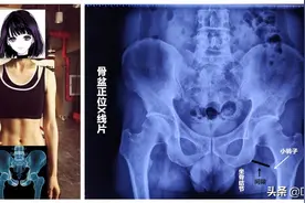 大胯痛，不一定是股骨头坏死，很有可能是坐骨股骨撞击综合征！图片