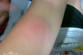 春日出游，一不留神娃被蚊子叮了大包，咋办呀图片