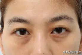 “祛眼袋”这件事，您试过几种"妙招"？说实话“还是手术靠谱”图片