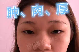 什么类型的肿眼泡/肿泡眼，别指望变薄眼皮？—眼整形双眼皮手术图片