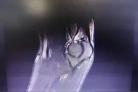 创伤后肘关节僵硬，这样治疗康复佳图片