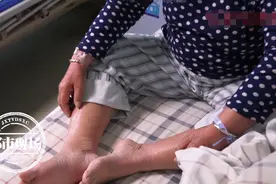 阿婆剧烈眩晕高喊救命，医生一看，她耳朵里的“石头”掉了图片
