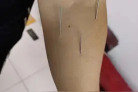 针灸治疗腓肠肌痉挛和手指麻木案例图片