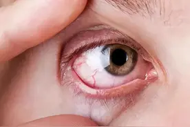 眼睛出现红血丝？可能是2种病，3个不良习惯，用这4个办法解决图片