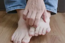 女孩脚气久治不愈，一查竟是梅毒所致！夏天，当心“梅毒”脚下起图片
