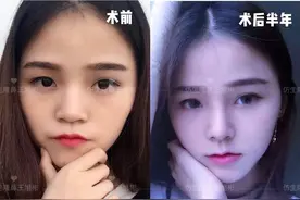 短鼻延长？揭秘中庭短、朝天鼻（猪鼻子）、挛缩鼻部整形原理方法图片