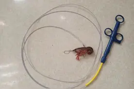 调皮的孩子把小龙虾塞进肛门，折腾自己7小时，被医生“钓”出来图片