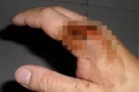 竹叶青又出现了，男子路边捡东西竟被咬到！手指差点保不住！图片