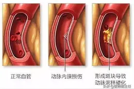 戒烟半年，突发心梗，45岁后戒烟到底好不好？突然戒烟伤害更大？图片