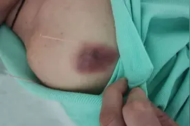 针灸出现淤青怎么办？会影响疗效吗？图片