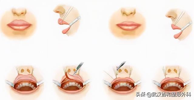 唇部整形,有哪些整形方法啊？（常见的唇部整形都有哪些）