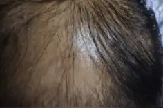 脱发容易，生发难？医生：试试激光生发，浓密黑发并不遥远图片