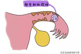 于萍：输卵管导致的不孕症，该如何治疗？解答患者的几个提问图片