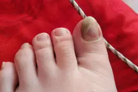 怎样让灰指甲变成好指甲？好经验分享给大家图片