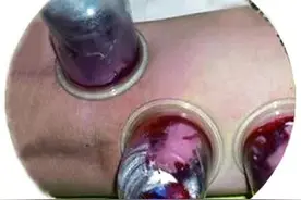 刺络放血疗法：清瘀血操作简便，消痼疾疗效迅速图片