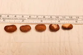 美国男子尿道塞入6颗芸豆，想变豌豆射手，结果塞惨了图片