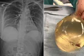 女子街头莫名中枪，隆胸硅胶救命图片