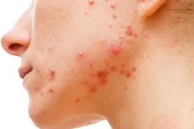 激光袪痘坑有风险吗？图片