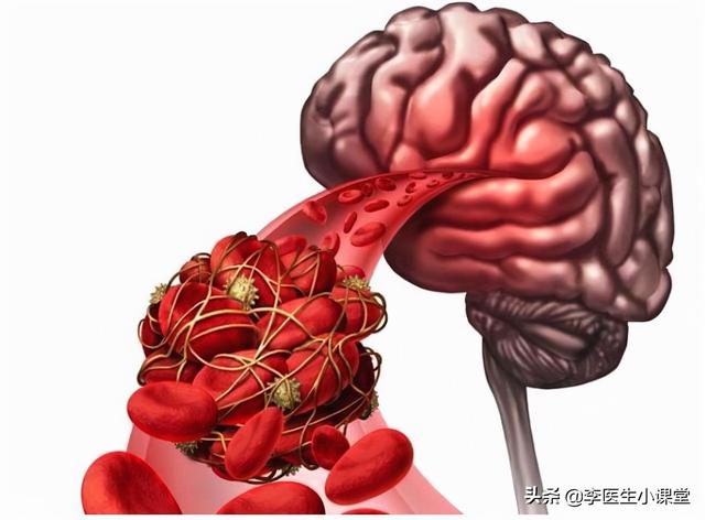 脑供血不足怎么办（脑供血不足）