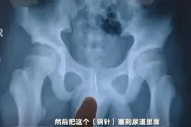 危险！13岁男孩为啥尿道藏9厘米钢针？有何危害？图片