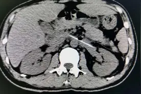 今年奇葩事特别多：剔牙误吞牙签，体内游走一个月终取出图片