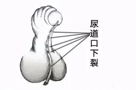 什么是尿道下裂？尿道下裂有哪些表现？尿道下裂有哪些危害？图片