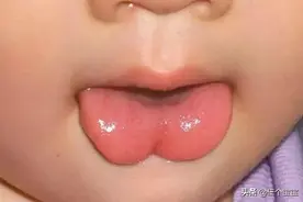 看看自家娃的舌头，如果出现这种形状，一定要注意图片