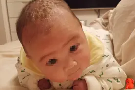 有种“手贱”叫抠婴儿乳痂，真是坑娃于无形，乳痂如何正确清理？图片