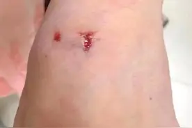 江苏疯狗接连咬伤21人！被狗咬了会怎么样，路遇恶犬如何随机应变图片