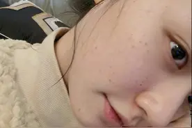 25岁星女郎林允自己做医美，满脸针眼好吓人，网友：看着都疼图片