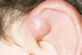 耳廓囊肿会自己消除吗？需要哪些干预手段？