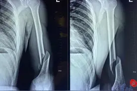 啪！28岁健身达人掰手腕，把手臂掰成粉碎性骨折图片