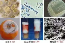 远离真菌，清凉一夏！——真菌性皮肤病图片