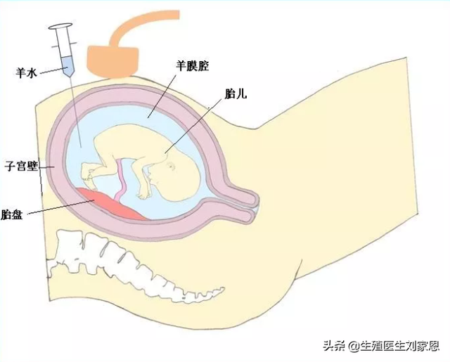 羊水穿刺能检查什么（孕期被要求做羊水穿刺检查）