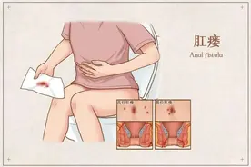 得了肛瘘，不能等，也不能拖图片
