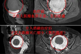 引发月经量过多、贫血的子宫肌瘤介入微创治疗世界图片