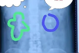 多年双肾结石引发贫血？身体里的石头千万不要轻视图片