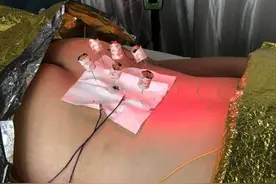 艾灸加电疗古今结合图片