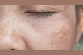 黄褐斑治不好？复发更难搞？这些治疗黄褐斑的方法你一定要看图片