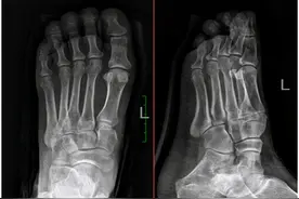 骨折病人拍完X线片后为什么还要“建议CT”呢？图片