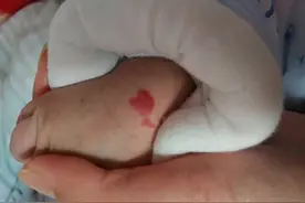 命越好的人胎记长得就越特殊？医生提示：这才是胎记的科学知识图片