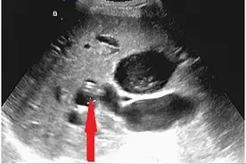 【新技术】超声科—超声引导下经皮经肝胆管穿刺置管引流术（PTCD）图片