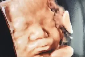 被四维照吓到，医生好心劝慰，孩子生下后宝妈直呼被医生“骗”啦图片